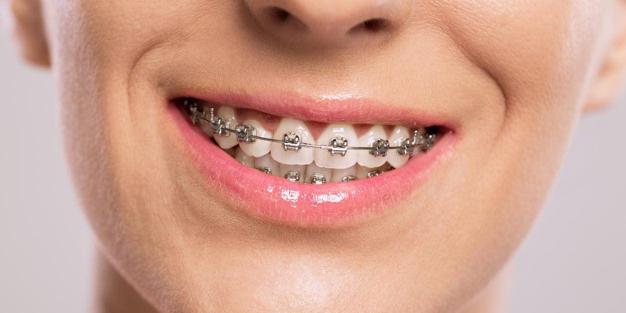Healthy smile with braces